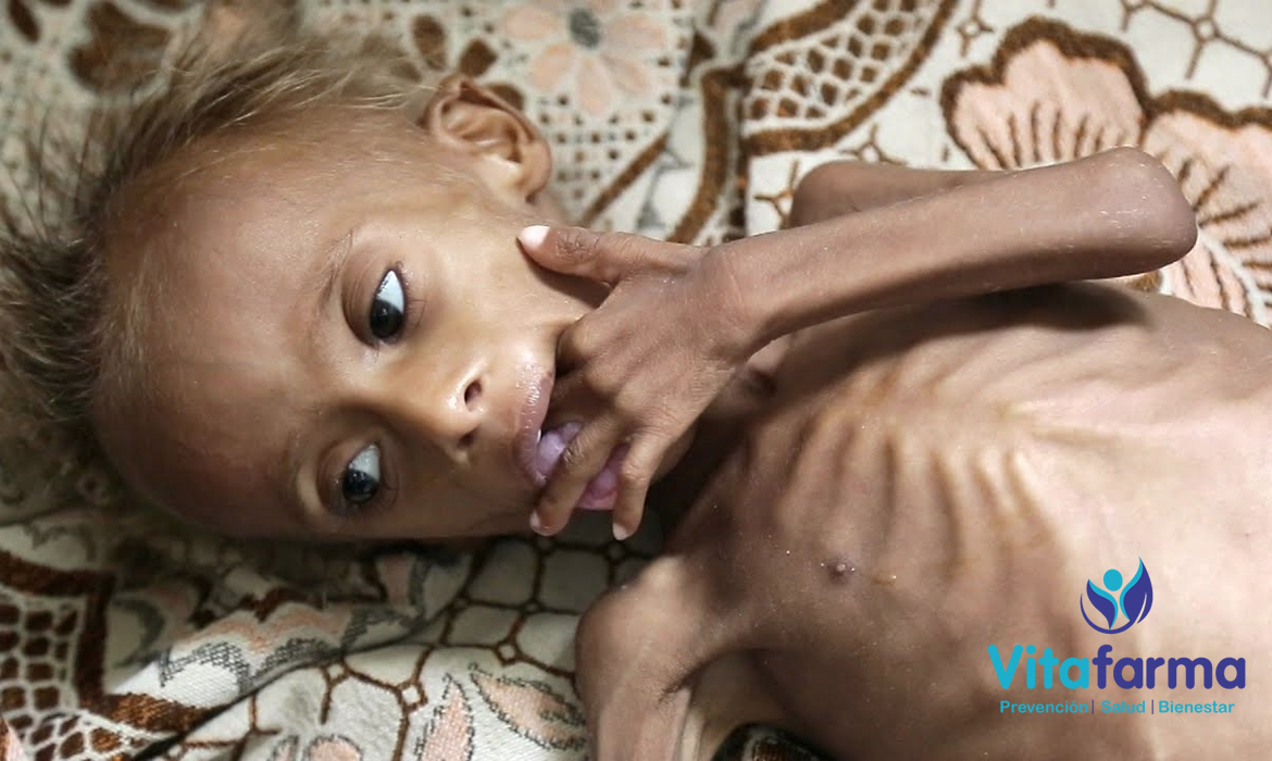 Anemia y malnutrición infantil
